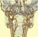 頸部血管VR