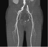 下肢動脈拡大VR