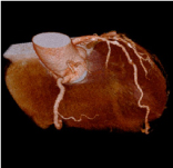 CTで撮影した心臓の血管の立体像