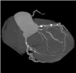 左と同じ患者様（中央に狭い血管）