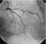 同患者のカテーテル検査写真