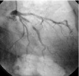 ステント留置後の改善
